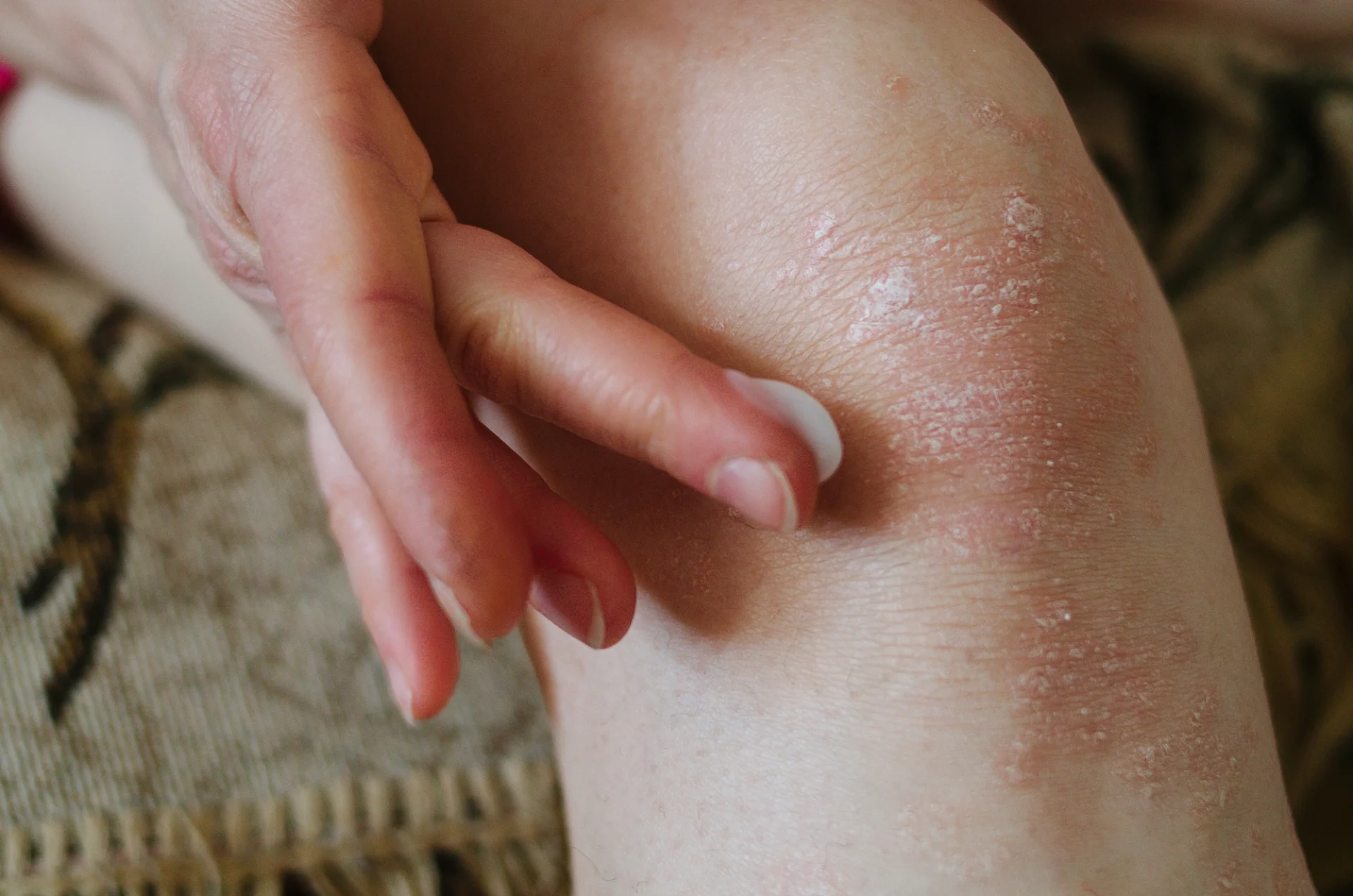 close up of a knee with eczema being treated with skin cream